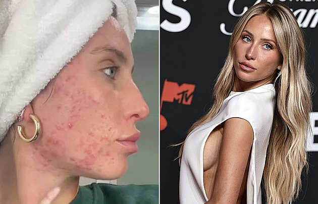 Kvůli akné modelka nechtěla vycházet z domu, po letech se ho zbavila